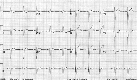 lv ecg|ecg findings in lvh.